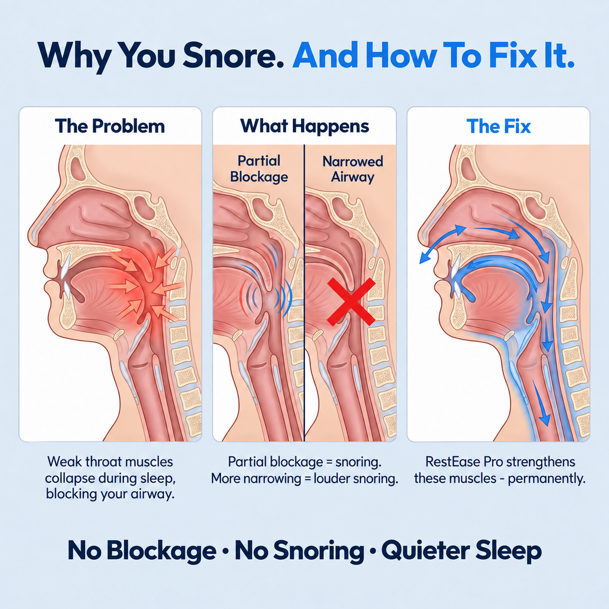 RestEase — Stop Snoring at the Source